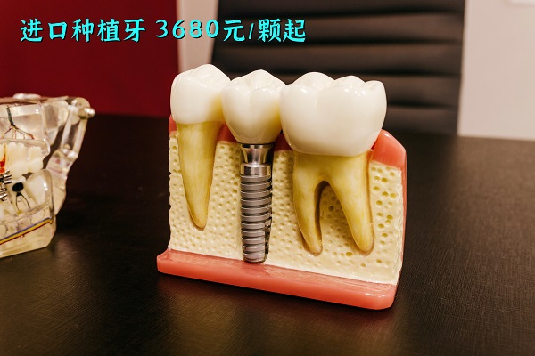 合肥鑲牙的價格表，3種鑲牙方式你pick哪一個？