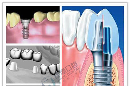 牙齒缺失后種牙好不好呢？