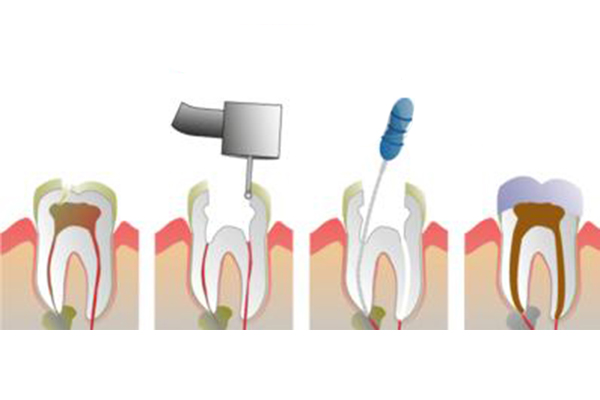 根管的治療有哪些的優勢呢？