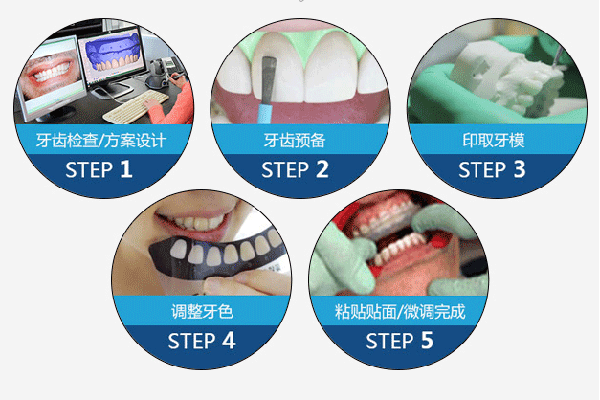 合肥瓷貼面美白牙齒多少錢一顆？